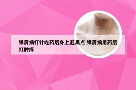 银屑病打针吃药后身上起黑点 银屑病用药后红肿痒