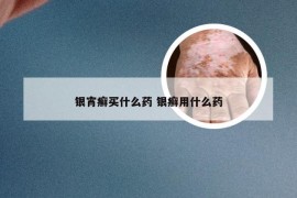 银宵癣买什么药 银癣用什么药