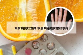 银屑病变红发痒 银屑病连成片很红很痒