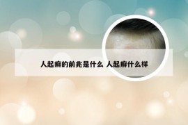 人起癣的前兆是什么 人起癣什么样