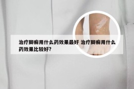 治疗脚癣用什么药效果最好 治疗脚癣用什么药效果比较好?