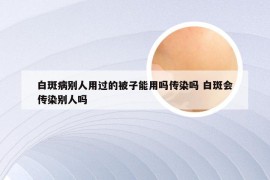 白斑病别人用过的被子能用吗传染吗 白斑会传染别人吗