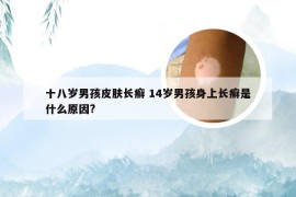 十八岁男孩皮肤长癣 14岁男孩身上长癣是什么原因?