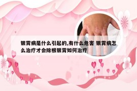 银霄病是什么引起的,有什么危害 银霄病怎么治疗才会除根银霄如何治疗