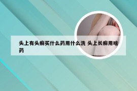 头上有头癣买什么药用什么洗 头上长癣用啥药