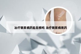 冶疗银屑病药能出根吗 治疗银屑病用药