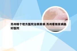 苏州哪个地方医院治银屑病 苏州看银屑病最好医院