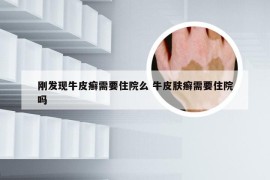 刚发现牛皮癣需要住院么 牛皮肤癣需要住院吗