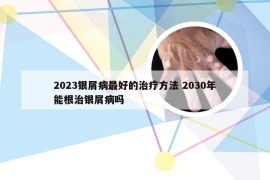 2023银屑病最好的治疗方法 2030年能根治银屑病吗