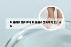 银屑病会流黄液吗 银屑病会流黄液吗怎么治疗