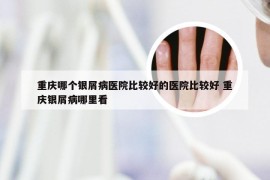 重庆哪个银屑病医院比较好的医院比较好 重庆银屑病哪里看