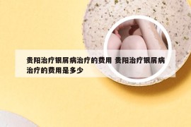 贵阳治疗银屑病治疗的费用 贵阳治疗银屑病治疗的费用是多少