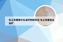 头上长癣有什么治疗的好办法 头上长癣怎么治疗