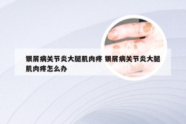 银屑病关节炎大腿肌肉疼 银屑病关节炎大腿肌肉疼怎么办