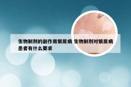 生物制剂的副作用银屑病 生物制剂对银屑病患者有什么要求