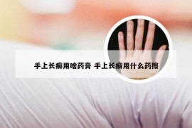 手上长癣用啥药膏 手上长癣用什么药擦