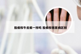 股癣和牛皮癣一样吗 股癣和银屑病区别