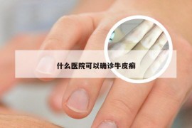 什么医院可以确诊牛皮癣