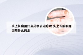 头上长癣用什么药物去治疗呢 头上长癣的原因用什么药水