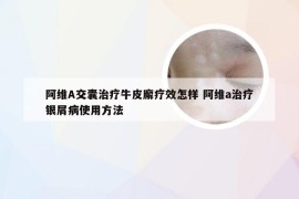 阿维A交囊治疗牛皮廨疗效怎样 阿维a治疗银屑病使用方法