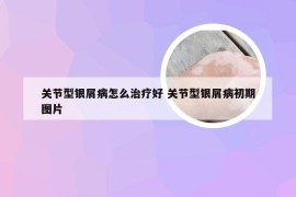 关节型银屑病怎么治疗好 关节型银屑病初期图片