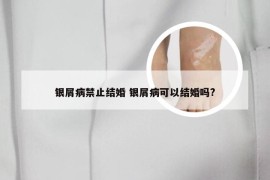 银屑病禁止结婚 银屑病可以结婚吗?