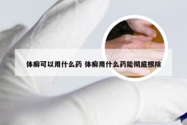 体癣可以用什么药 体癣用什么药能彻底根除