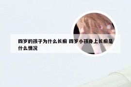 四岁的孩子为什么长癣 四岁小孩身上长癣是什么情况