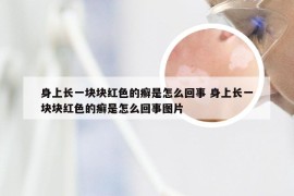 身上长一块块红色的癣是怎么回事 身上长一块块红色的癣是怎么回事图片