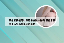 黑色素移植可以和原来皮肤一样吗 黑色素移植多久可以恢复正常皮肤