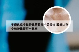 手癣达克宁和特比萘芬哪个见效快 股癣达克宁和特比萘芬一起用