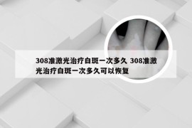 308准激光治疗白斑一次多久 308准激光治疗白斑一次多久可以恢复