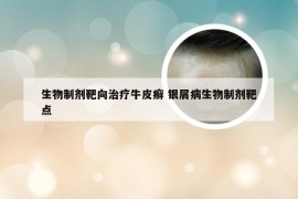 生物制剂靶向治疗牛皮癣 银屑病生物制剂靶点