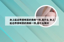 身上起边界很明显的像癣一样,是什么 身上起边界很明显的像癣一样,是什么情况