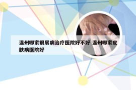 温州哪家银屑病治疗医院好不好 温州哪家皮肤病医院好