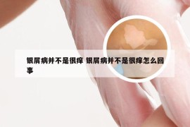 银屑病并不是很痒 银屑病并不是很痒怎么回事