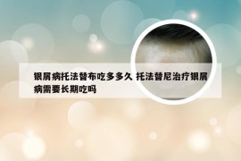 银屑病托法替布吃多多久 托法替尼治疗银屑病需要长期吃吗