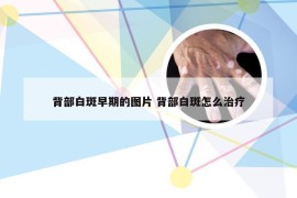 背部白斑早期的图片 背部白斑怎么治疗