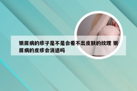 银屑病的疹子是不是会看不出皮肤的纹理 银屑病的皮疹会消退吗