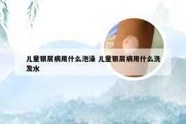 儿童银屑病用什么泡澡 儿童银屑病用什么洗发水