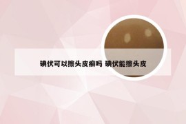 碘伏可以擦头皮癣吗 碘伏能擦头皮