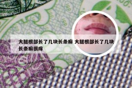 大腿根部长了几块长条癣 大腿根部长了几块长条癣很痒