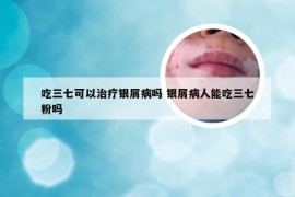 吃三七可以治疗银屑病吗 银屑病人能吃三七粉吗