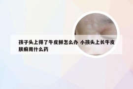 孩子头上得了牛皮鲜怎么办 小孩头上长牛皮肤癣用什么药