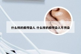 什么样的癣传染人 什么样的癣传染人不传染