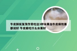 牛皮鲜反复发作常吃这3种水果治牛皮癣效果都说好 牛皮廨吃什么水果好