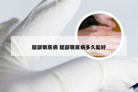 腿部银屑病 腿部银屑病多久能好