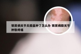 银屑病关节炎膝盖肿了怎么办 银屑病膝关节肿胀疼痛