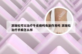 派瑞松可以治疗牛皮癣吗有副作用吗 派瑞松治疗手癣怎么样