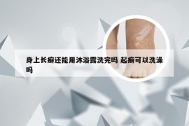 身上长癣还能用沐浴露洗完吗 起癣可以洗澡吗